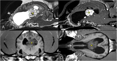 Transcallosal Removal of a Choroid Plexus Tumor From the Lateral Ventricle in a Dog. Case Report